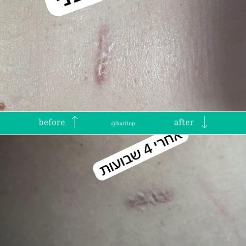 צלקות לפני ואחרי טיפול